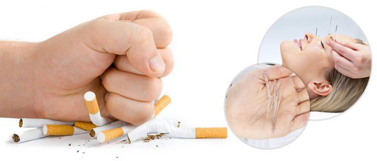 Acupuntura para dejar de fumar: ¿Sirve de verdad?