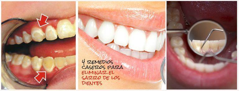 Cómo eliminar el sarro de los dientes de forma natural