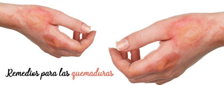 Soluciones caseras para las quemaduras