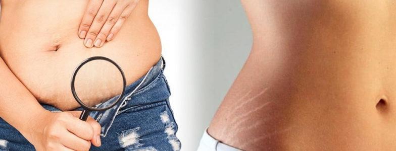 Conoce cuáles son las principales causas de las estrías y cómo evitarlas